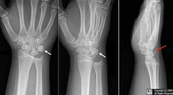 carpal fracture